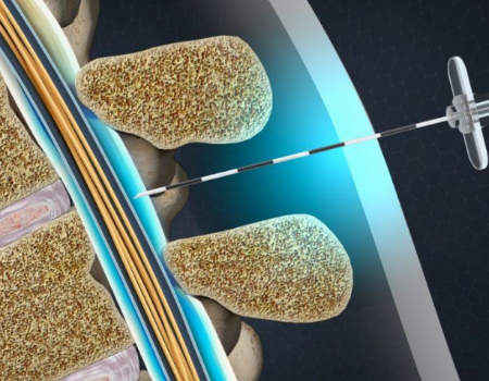 epidural steroid injection graphic