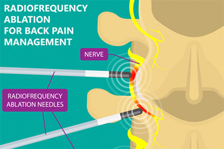 radiofrequency ablation for back pain management service