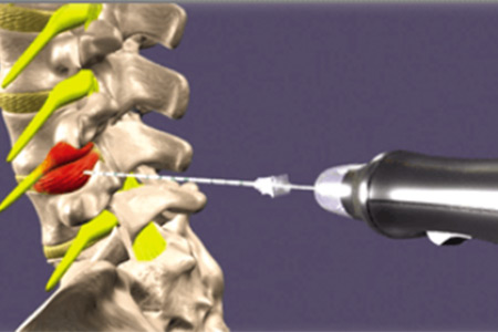 spinal injection for pain treatment service