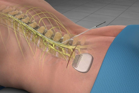spinal stimulation graphic