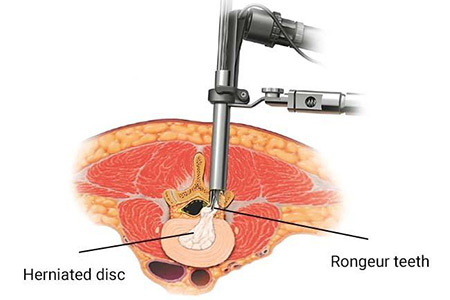 herniated disc treatment graphic