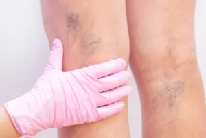varicose vein treatment