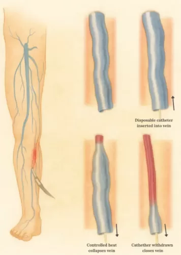endovenous radiofrequency ablation graphic